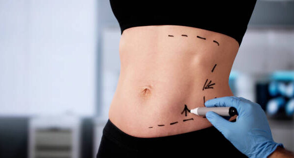 Difference Between Mini and Full Tummy Tuck Surgery?