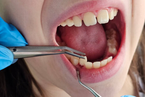 Does Tooth Removal Help With Chronic Tooth Pain