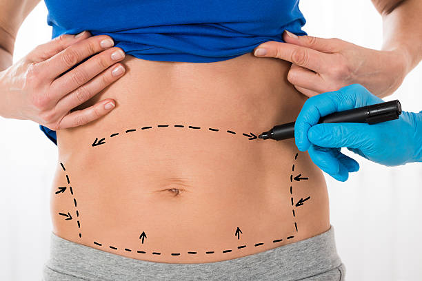 How Lipo Abdominoplasty Targets Loose Skin Issues