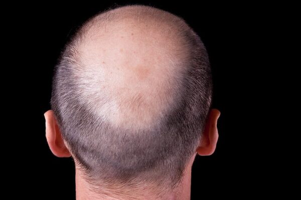 How Long Do Results Last After Crown Hair Transplant