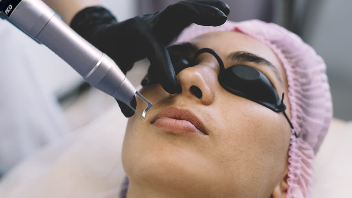 How Pico Laser Treatment Boosts Skin Clarity