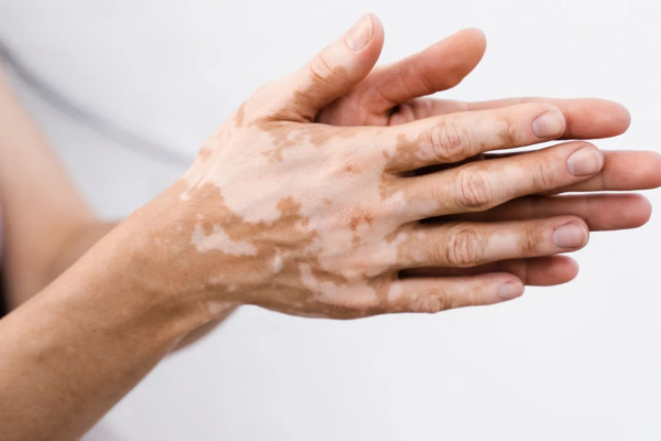 How Vitiligo Treatment Enhances Quality of Life