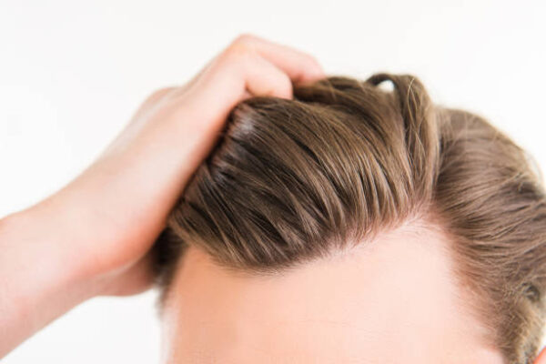 Is FUE Hair Transplant Suitable for Early Hair Loss