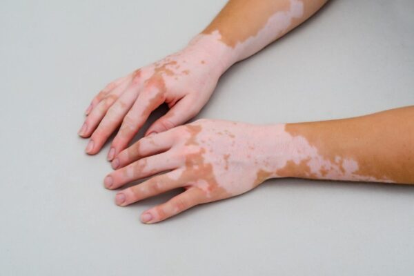 Is Vitiligo Treatment Effective for Early Stages